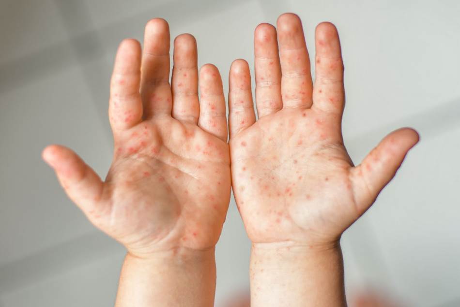 Bolest prljavih ruku