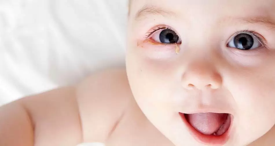 Konjuktivitis kod beba