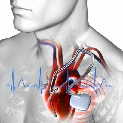 U Opštoj bolnici počela primena tehnologije „Implantacija pejsmejkera i kardioverter defibrilitarora“